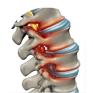 Slip disc diagnosis and treatment by Dr. Nikhil Arbatti