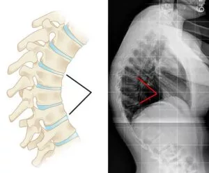 Side view of the thoracic spine showing kyphotic curvature