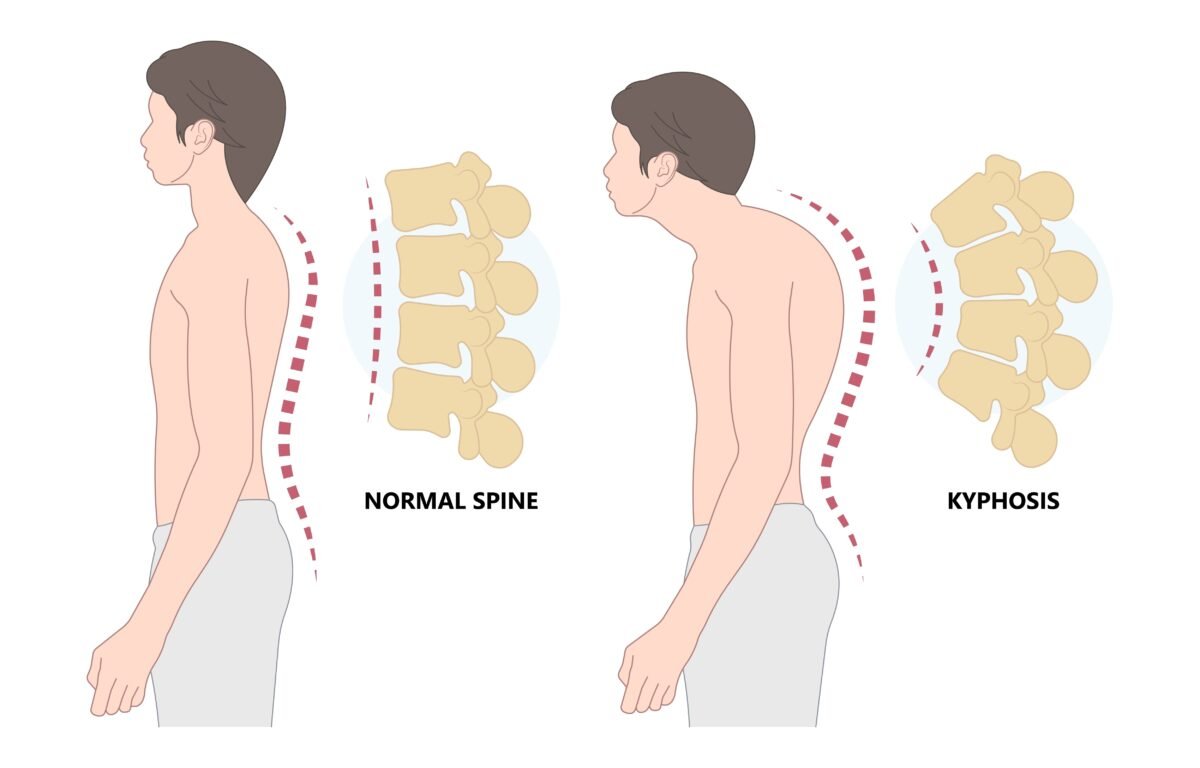 Kyphosis showing excessive forward curvature of the spine