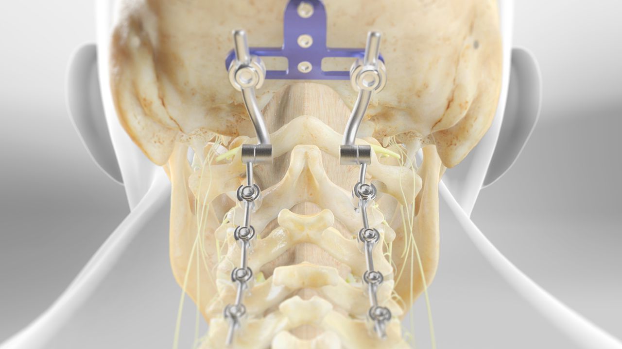 Advanced Surgery for Cervical Spinal Cord & Nerve Compression by dr nikhil arbatti