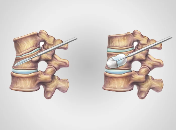 Microscopic Discectomy y dr nikhil arbatti