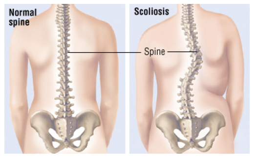 Scoliosis Correction Surgery
