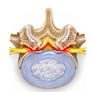 Spinal stenosis diagnosis and treatment in Mumbai